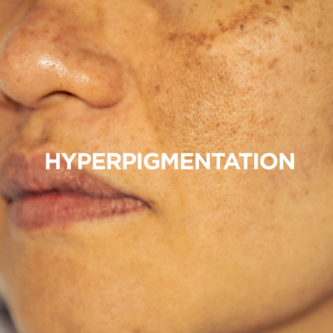 Hyperpigmentation