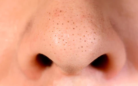 How to remove Nose Pores: A Step-by-Step Guide to Reducing Their Appearance.