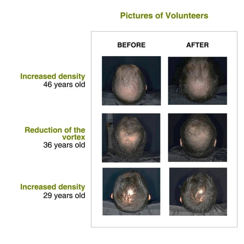 Increased hair density after using rosemary redensyl hair serum