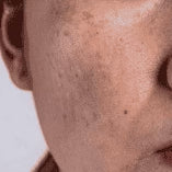 Dark spots & Pigmentation